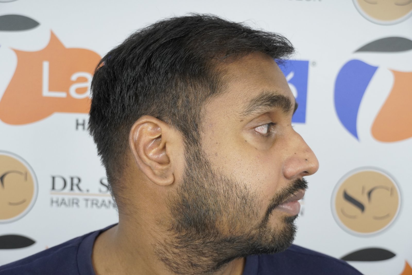 Shreyankar Maurya After Hair Transplant
